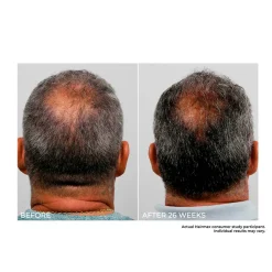 Cordless Hair Growth Comb