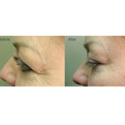 Full Face Professional Light Therapy System