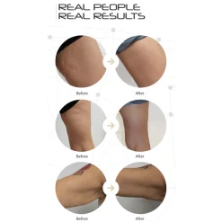 LED Cellulite Reducing Device