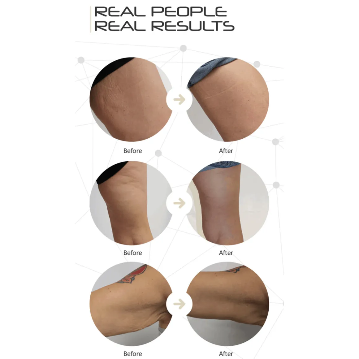 LED Cellulite Reducing Device
